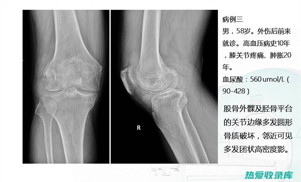 红柳枝中的抗炎成分患者的和