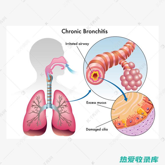 支气管炎