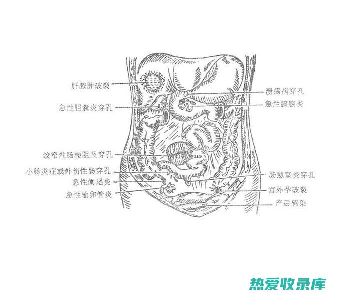 腹痛(腹痛一阵一阵的绞痛)