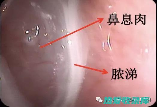 鼻窦炎的神奇中医偏方：告别鼻塞、流涕、头痛的秘密武器 (鼻窦炎的神奇治疗方法)