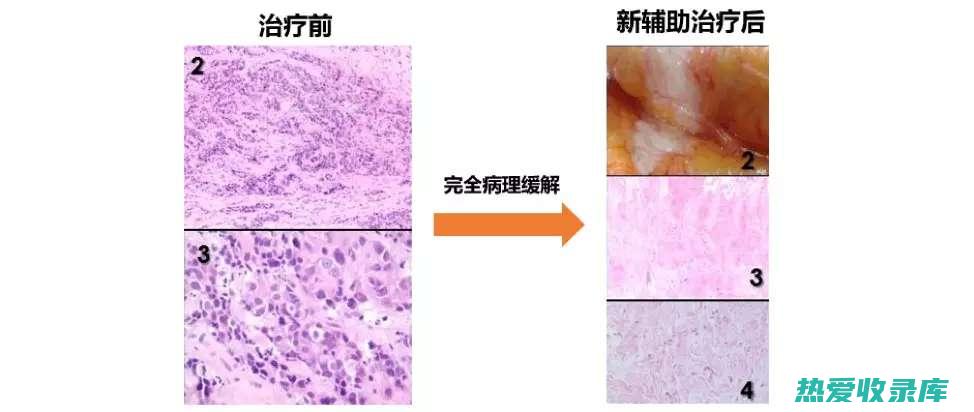 肿瘤辅助治疗(肿瘤辅助治疗是什么意思)