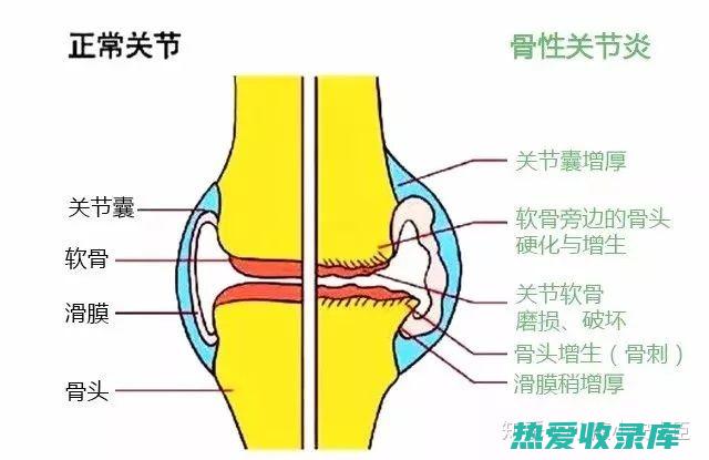 关节炎(关节炎怎么治疗最好最有效的药)