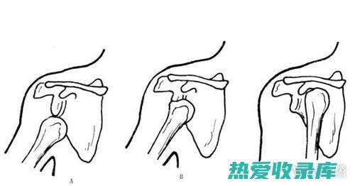 中药治疗脱臼：古老且有效的自然疗法 (中药治疗脱臼的方子)