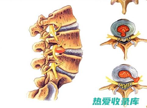 腰椎间盘突出特效中药药酒秘方大公开，亲测有效，不再受疼痛困扰 (腰椎间盘突出最好的治疗方法)