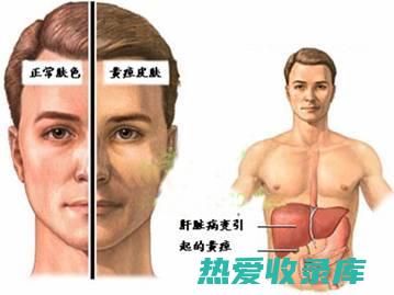 黄疸型肝炎：具有退黃、保護肝细胞的作用。(黄疸型肝炎的症状有哪些)