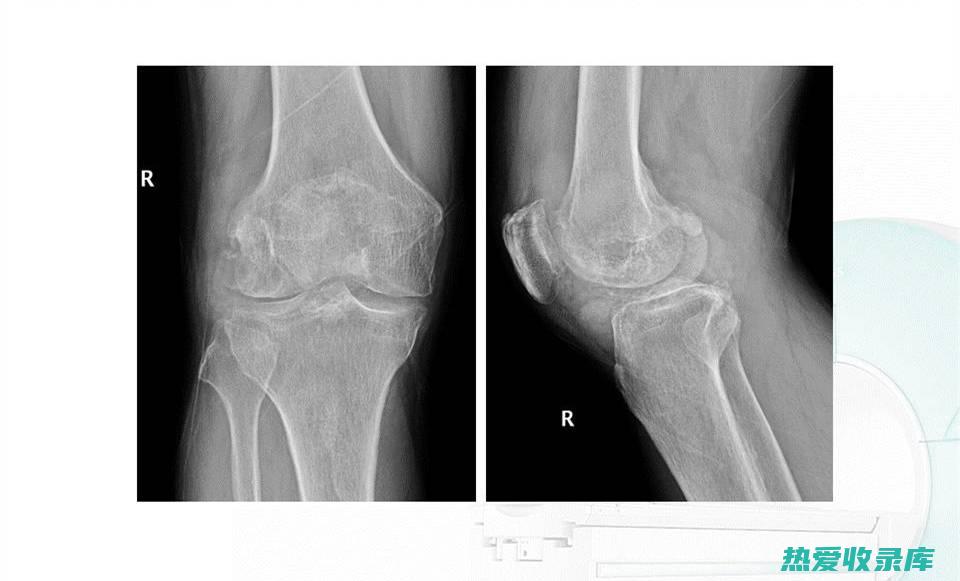 骨性关节炎：中医药治疗方法 (骨性关节炎的主要症状有哪些)