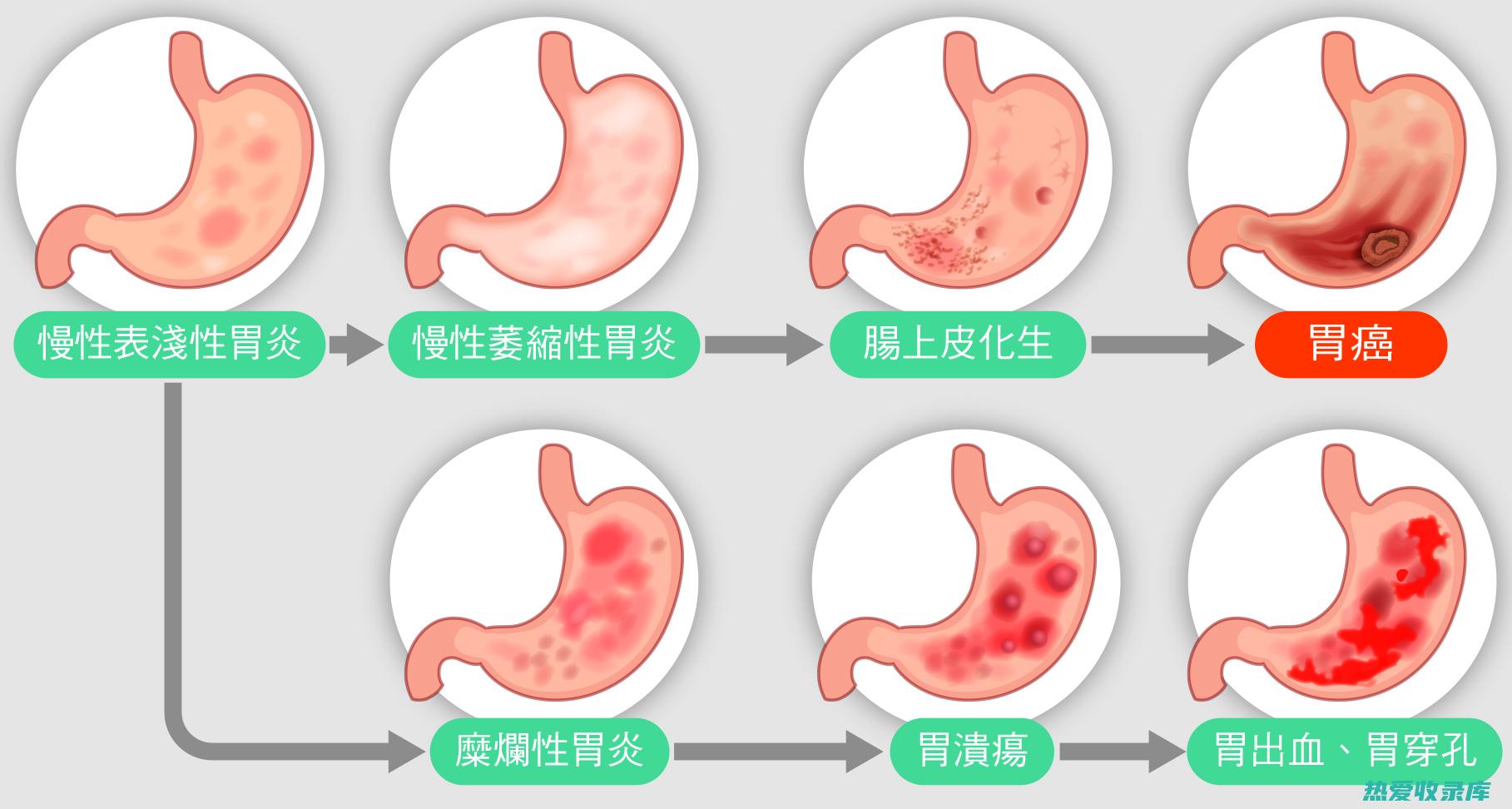 消化不良(消化不良有几大类危害)