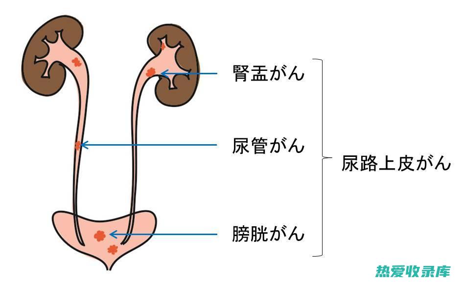 如膀胱炎