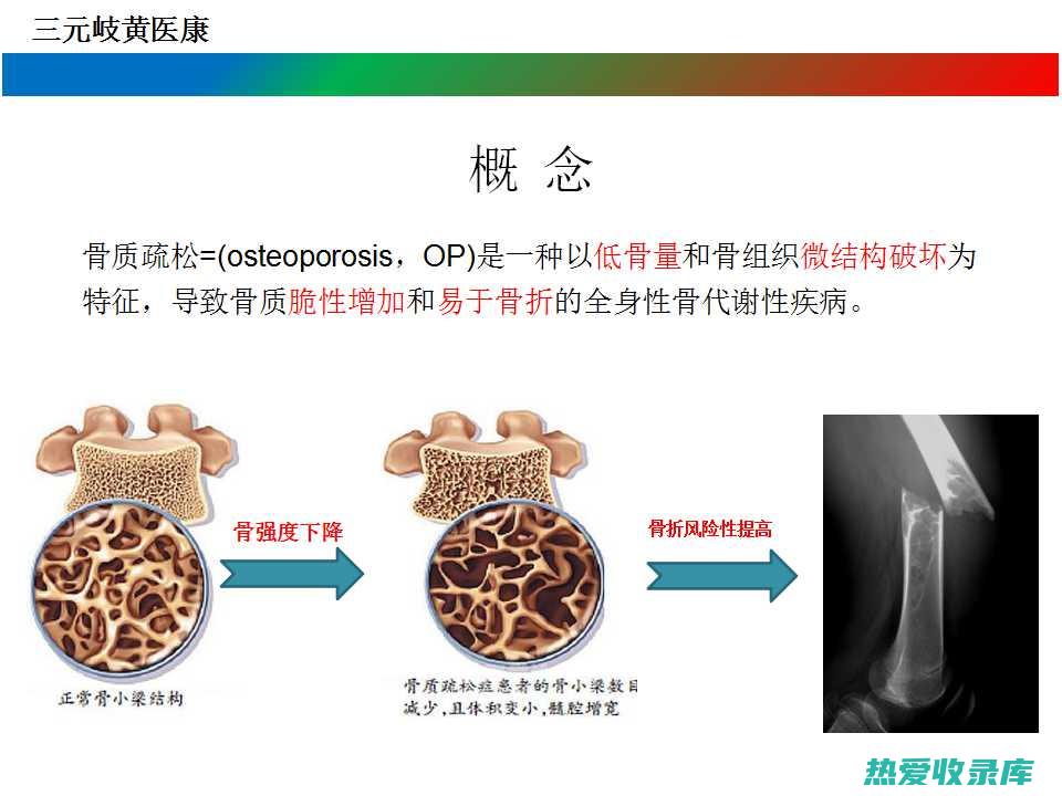 骨质疏松：骨碎补可以补肾强骨，补充钙质，辅助治疗骨质疏松。(骨质疏松骨密度测定的诊断标准)