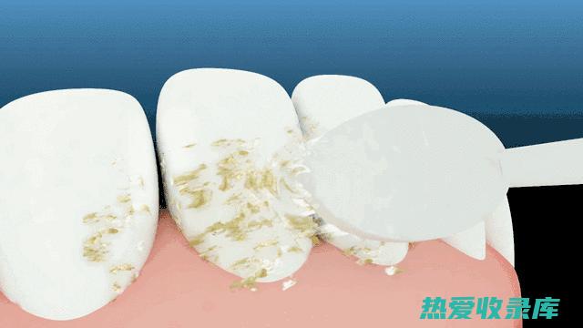 牙垢堆积导致牙龈肿痛