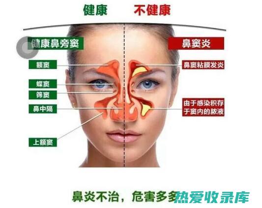 鼻窦感染(鼻窦感染什么症状)