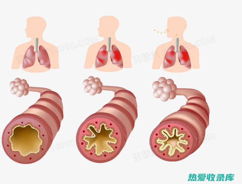 支气管炎、哮喘：守宫粉10-20克，与(支气管炎哮喘症状及表现)