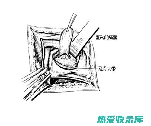 腹股沟管痛