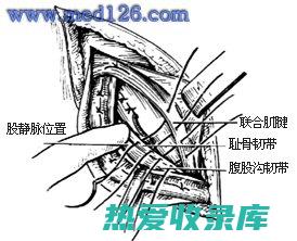 腹股沟韧带拉伤或扭伤(腹股沟韧带拉伤表现)