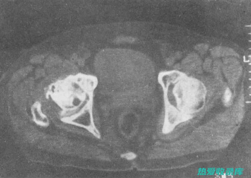 股骨头缺血坏死的中药疗法：传统智慧与现代医学的融合 (股骨头缺血坏死的治疗方法)