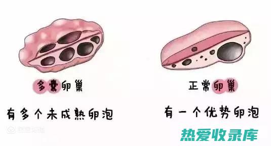 多囊卵巢综合征（PCOS）(多囊卵巢综合症)