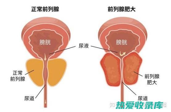 前列腺疾病的中药疗法