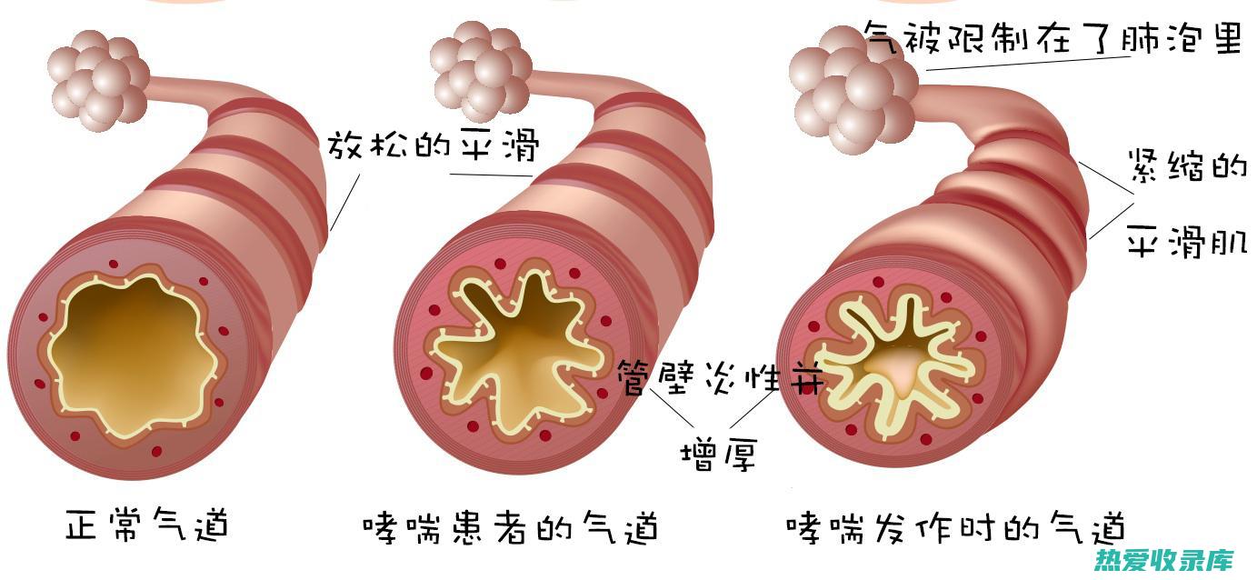 哮喘：表现为反复发作的喘息、气促、胸闷等症状。(心源性哮喘表现为)