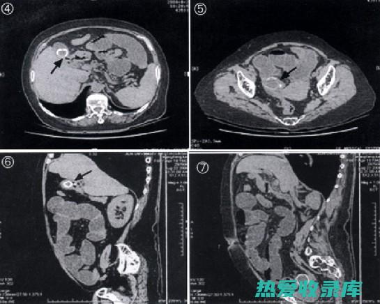 有胆结石或胆囊疾病的人(有胆结石或胆囊炎可以吃鸡蛋吗)