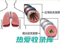 慢性支气管炎(慢性支气管炎吃什么药好)