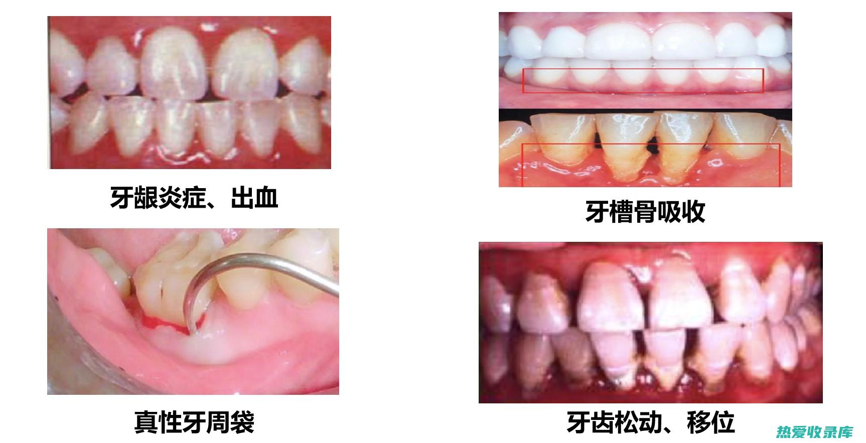 治疗炎症：南蛇勒用于治疗关节炎、牛皮癣和溃疡性结肠炎等炎症性疾病。(治疗炎症的偏方)