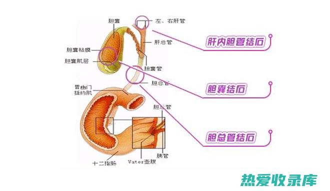 胆囊炎(胆囊炎要怎么治疗)