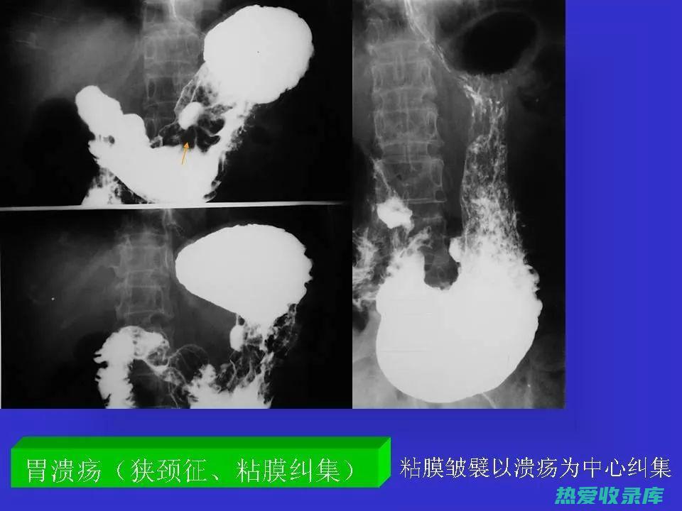 胃溃疡和十二指肠溃疡患者慎用，以免刺激胃黏膜。(胃溃疡和十二指肠溃疡的区别)