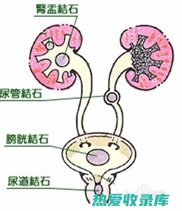 尿路结石最好的排石