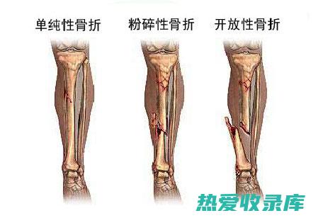 后常用的内固定方式为