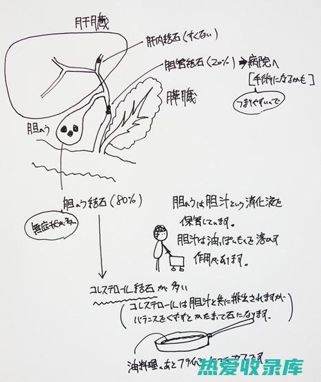 胆石症(胆石症的主要症状)