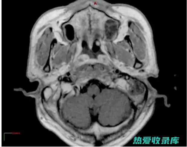 肿瘤：鼻咽癌、肺癌等。(肿瘤鼻咽癌)