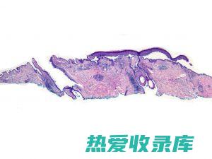 天疱疮的中药治疗：古方智慧，有效且自然 (天疱疮的中药偏方)