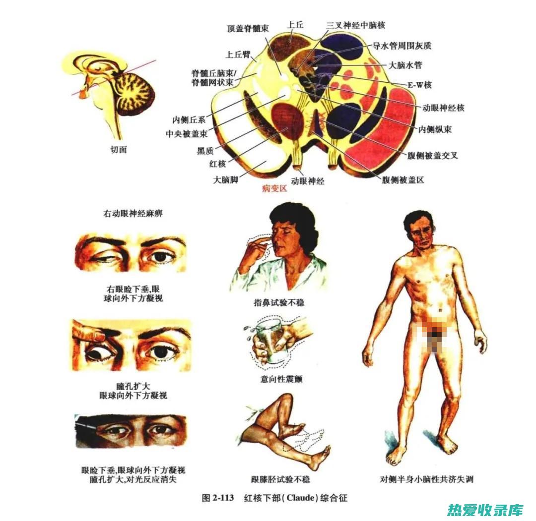 神经系统疾病：头痛、眩晕、中风等。(神经系统疾病都有哪些症状)