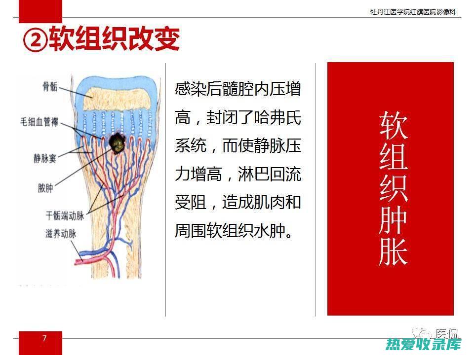 促进骨髓炎的愈合