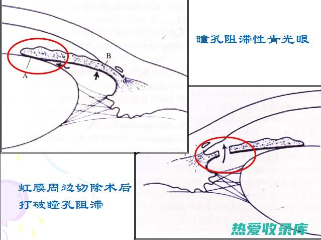 青光眼、前列腺肥大患者慎用(青光眼前列腺肥大患者应慎用的镇咳药是)