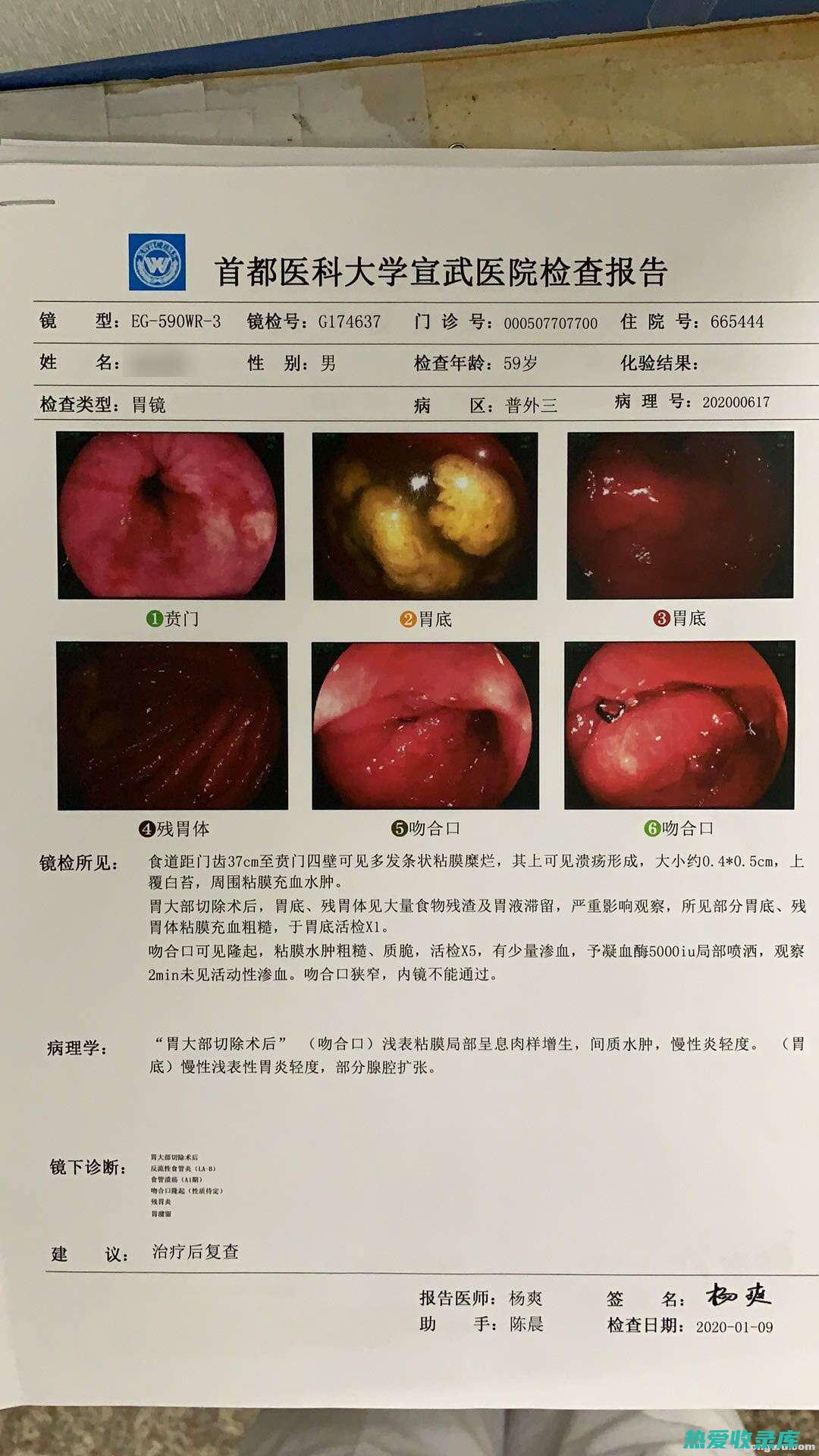 浅表性胃炎的