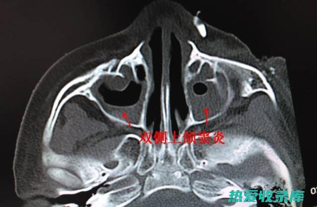 治鼻窦炎的中药材