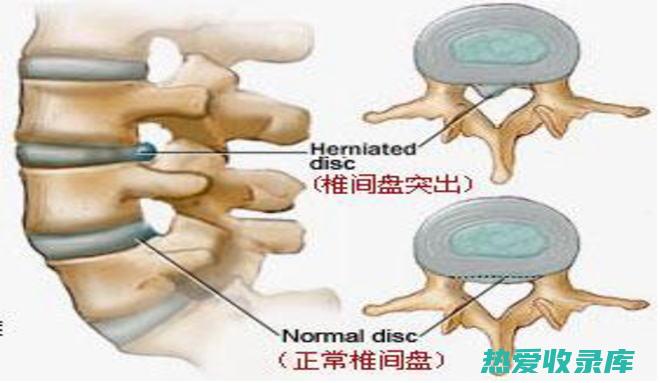 腰椎间盘突出外敷良方：传统中药的治愈之道 (腰椎间盘突出最有效的恢复方法)