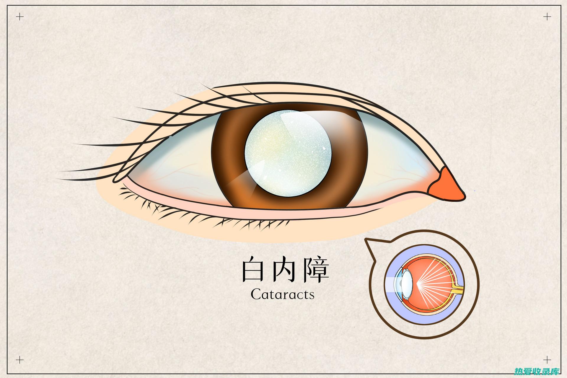 白内障严重或并发其他眼疾时，应及时就医，必要时进行手术治疗。(白内障严重或者严重)