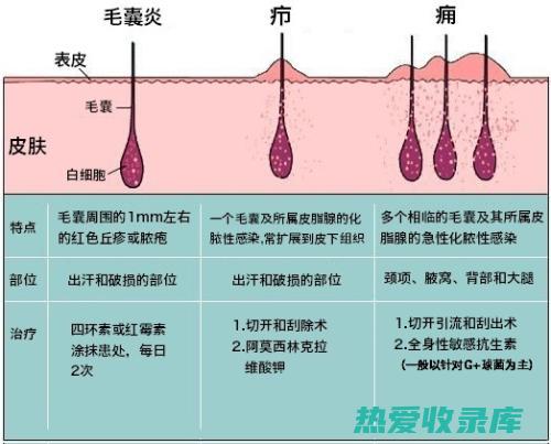 治疗皮肤炎症和伤口感染(治疗皮肤炎症的口服消炎药)