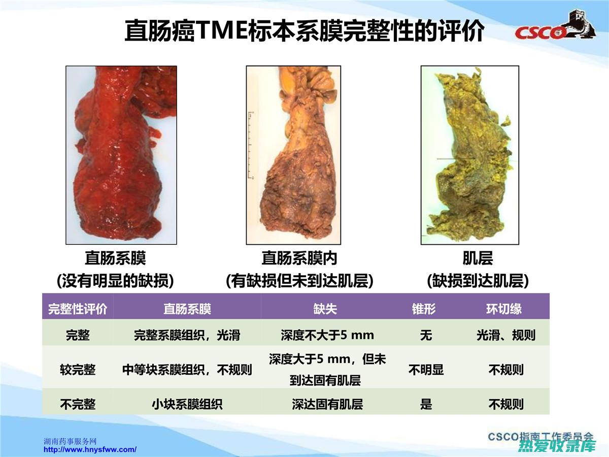 肠癌中药：综合性治疗方案中的关键辅助剂 (肠癌的中药)