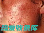 疮疡和皮肤感染(疮疡和皮肤感染的区别)