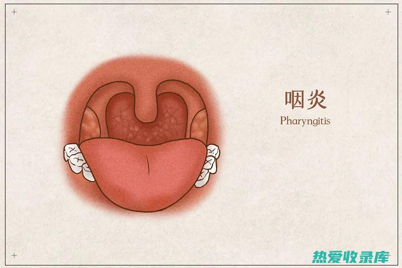 缓解咽炎的中医良方 (缓解咽炎的中药)