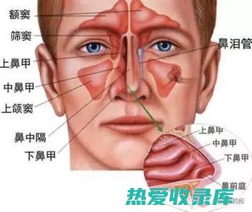 鼻窦炎(鼻窦炎的症状及表现)