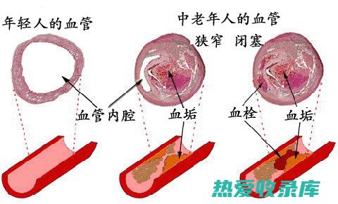 血栓形成(血栓形成的名词解释)