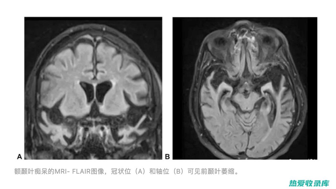 影像学检查，如头颅CT或MRI(影像学检查是什么意思)