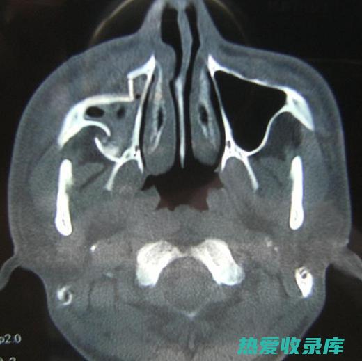 鼻窦感染：头部外伤可能导致鼻窦感染，这可能导致头痛、鼻塞和面部疼痛等症状。(鼻窦感染头疼怎么办)