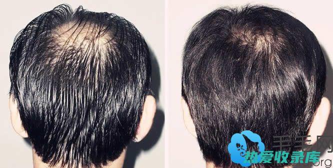 脂溢性脱发的中药治疗方案 (脂溢性脱发的原因)