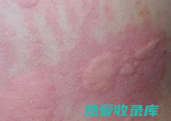 荨麻疹：白鲜皮的清热凉血功效可以缓解荨麻疹引起的皮肤瘙痒、红肿等症状。(荨麻疹白鲜皮)