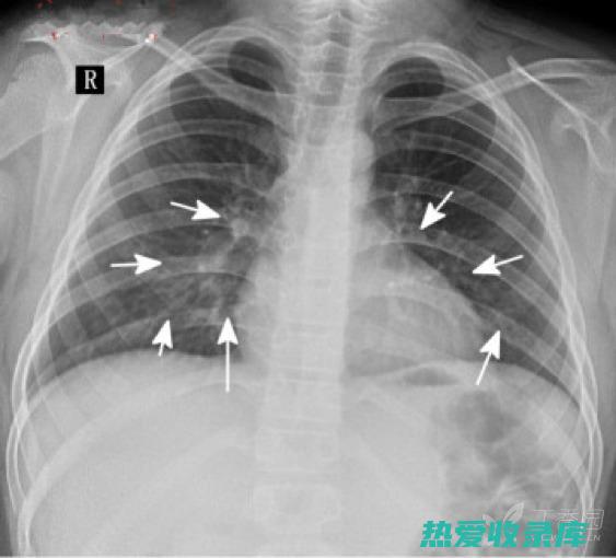 肺炎、支气管炎：红海哈具有消炎镇痛的功效，可用于治疗肺炎、支气管炎等呼吸系统疾病。(肺炎支气管炎吃什么药好)